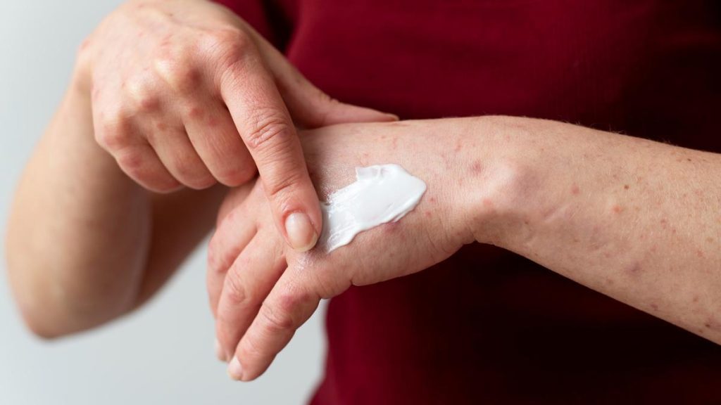 Los Mejores Remedios Curativos para Combatir las quemaduras